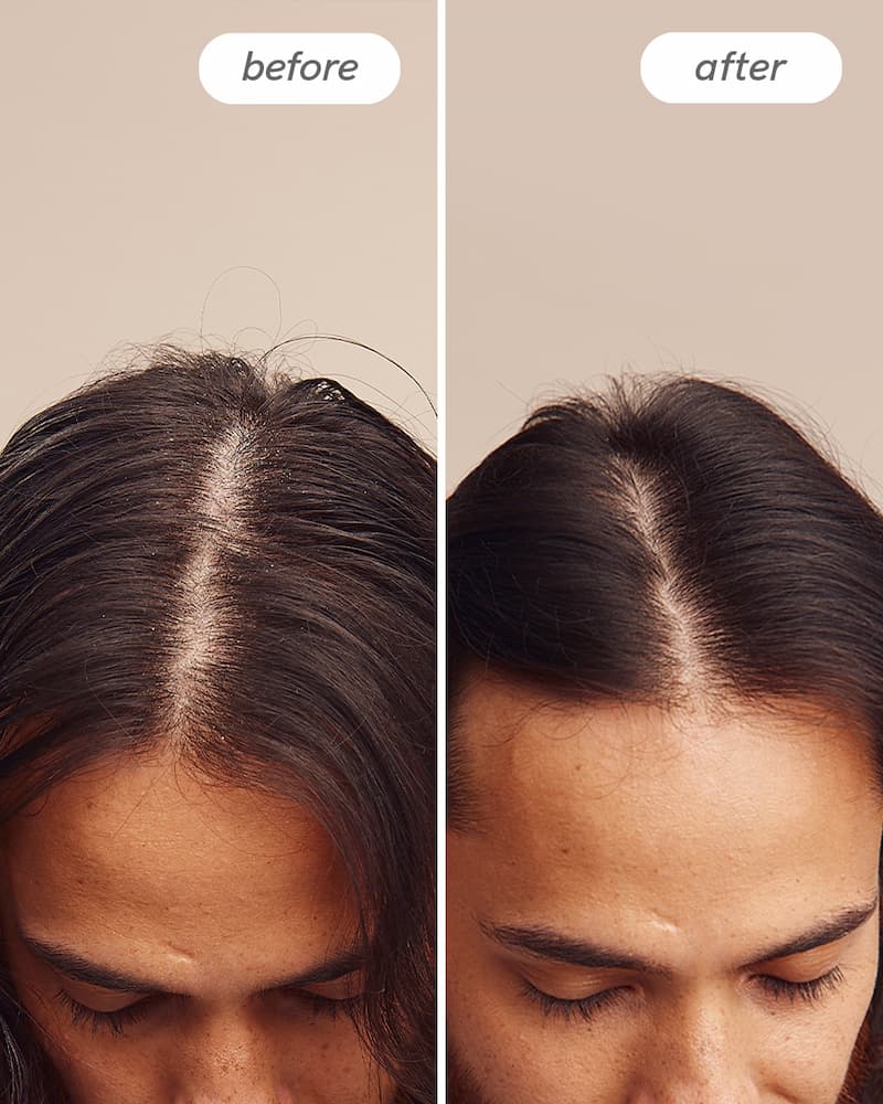 Instant Relief™ Dandruff Shampoo - Image 9